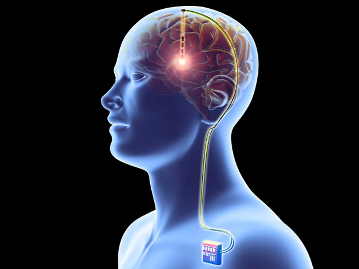 Brain Pacemaker (DBS)
